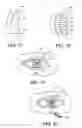 Fig. 08 - Ocular inlay with locator
