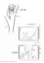 Fig. 06 - Intra-bronchial obstructing device that controls biological interaction with the patient