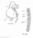 Fig. 44 - Instruments having a rigidizable external working channel