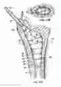 Fig. 08 - Cavity formation device