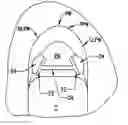Fig. 01 - Pharyngeal wall treatment