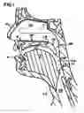Fig. 02 - Pharyngeal wall treatment