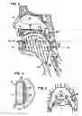 Fig. 03 - Pharyngeal wall treatment