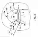 Fig. 05 - Pharyngeal wall treatment