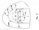 Fig. 06 - Pharyngeal wall treatment