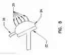 Fig. 07 - Pharyngeal wall treatment