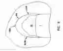 Fig. 08 - Pharyngeal wall treatment