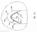 Fig. 09 - Pharyngeal wall treatment