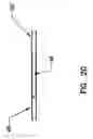 Fig. 19 - Pharyngeal wall treatment