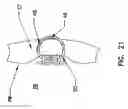 Fig. 20 - Pharyngeal wall treatment