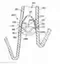 Fig. 01 - Removable anchored lung volume reduction device and methods