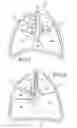 Fig. 02 - Removable anchored lung volume reduction device and methods