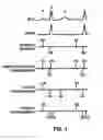 Fig. 02 - Method and apparatus for identifying oversensing using far-field intracardiac electrograms and marker channels