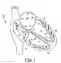 Fig. 02 - Optimization of AV intervals in single ventricle fusion pacing through electrogram morphology