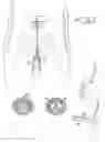 Fig. 01 - Controlled penile prosthesis