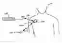 Fig. 01 - Patient event marking in combination with physiological signals