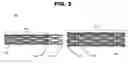 Fig. 04 - Overlapping coated stents method