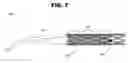 Fig. 08 - Overlapping coated stents method