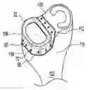 Fig. 01 - Cartilage implant