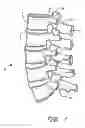 Fig. 02 - Flanged interbody fusion device with fastener insert and retaining ring