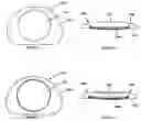 Fig. 02 - Intervertebral implant having features for controlling angulation thereof