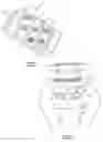 Fig. 10 - Intervertebral implant having features for controlling angulation thereof