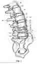 Fig. 02 - Artificial prosthesis
