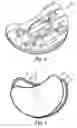Fig. 07 - Artificial prosthesis