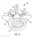 Fig. 05 - Flanged interbody fusion device with hinge