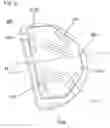 Fig. 06 - Unicondylar knee implant