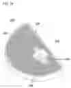 Fig. 11 - Unicondylar knee implant