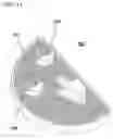 Fig. 12 - Unicondylar knee implant