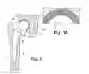 Fig. 03 - Surgical kit for hemiarthroplasty hip replacement