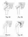 Fig. 04 - Surgical kit for hemiarthroplasty hip replacement
