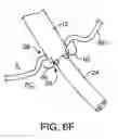 Fig. 16 - Transgastric abdominal access