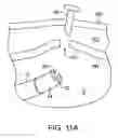 Fig. 23 - Transgastric abdominal access
