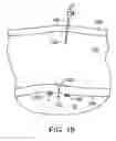 Fig. 30 - Transgastric abdominal access