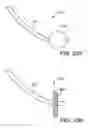 Fig. 31 - Transgastric abdominal access