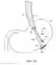 Fig. 34 - Transgastric abdominal access