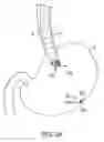 Fig. 35 - Transgastric abdominal access