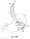 Fig. 37 - Transgastric abdominal access