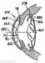 Fig. 01 - OPHTHALMIC LENS COMBINATIONS