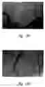 Fig. 32 - Anti-angiogenic compositions and methods of use