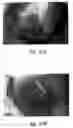 Fig. 76 - Anti-angiogenic compositions and methods of use