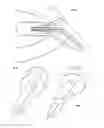 Fig. 11 - Dental implant with an integral structure comprising a stump completely or partially realized in advance