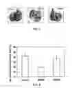 Fig. 04 - Treatment of hyperproliferative disease