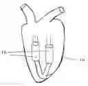 Fig. 01 - In vivo device for improving diastolic ventricular function