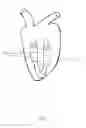 Fig. 06 - In vivo device for improving diastolic ventricular function