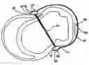 Fig. 01 - Methods and devices for improving mitral valve function