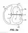 Fig. 03 - Methods and devices for improving mitral valve function